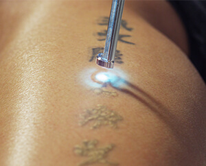 Permanent tattoo removal | Laser treatment for tattoo | Tattoo surgery