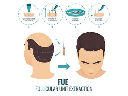FUE Follicular Unit Extraction 