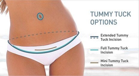 popular types of tummy tucks