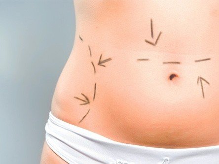  tummy tuck surgery