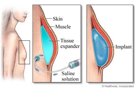 Breast Implants Process