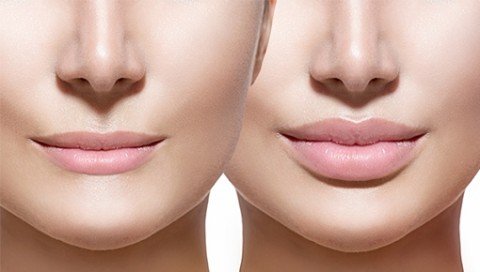 Dermal Fillers