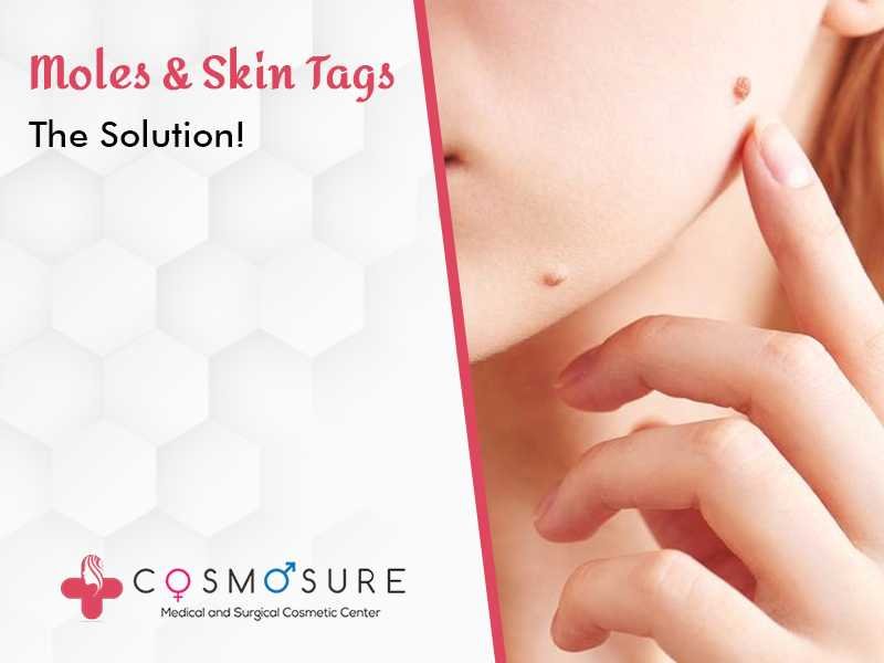 Removing Moles and Skin Tags at cosmosure clinic, one of the best skin and hair care centre in hyderabad