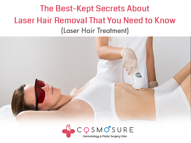 The Best-Kept Secrets About Laser Hair Removal That You Need To Know - (Laser  Hair Treatment) | Cosmosure Clinic