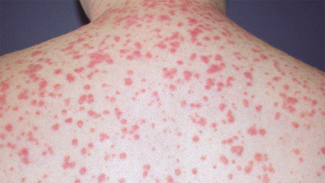 Best Psoriasis treatment by Dr Swapna Priya, one of the best Dermatology Doctor in Hyderabad
