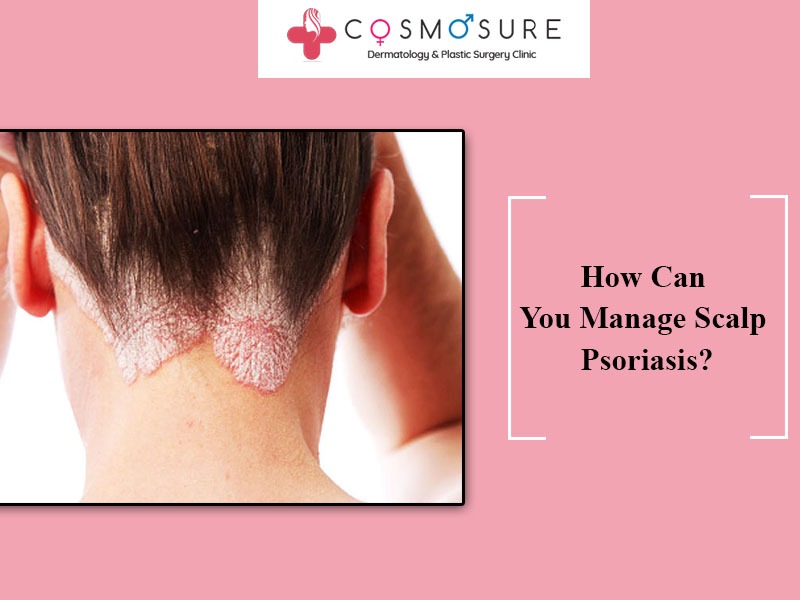 Contact for Best Treatment for Scalp Psoriasis by Dr Swapna Priya, One of the best dermtology specialist in Hyderabad