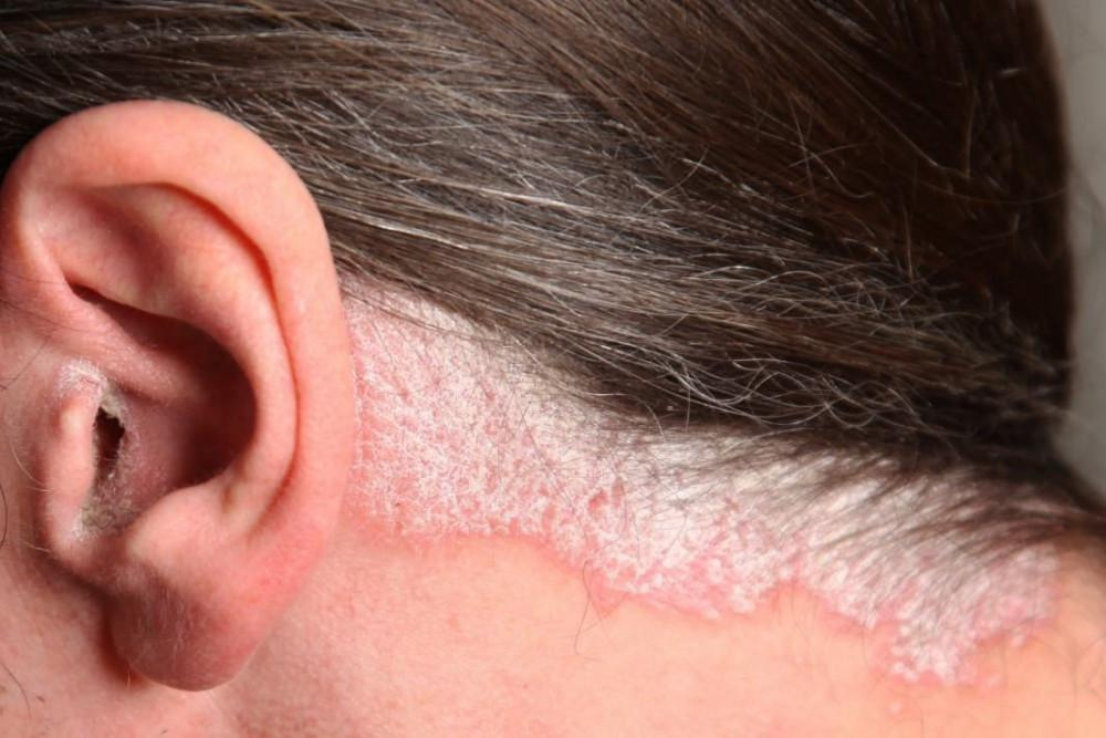 Contact now Scalp Psoriasis treatment by Dr Swapna Priya, best skin specialist near me