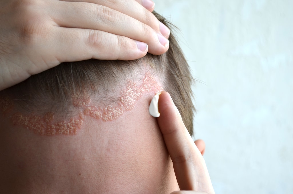 Get today Scalp Psoriasis Treatment in Hyderabad by Dr Swapna Priya at Cosmosure Clinic