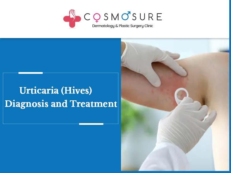 Get today Best Urticaria procedure by Dr. Swapna Priya, one of the best Dermatology doctor in Hyderabad
