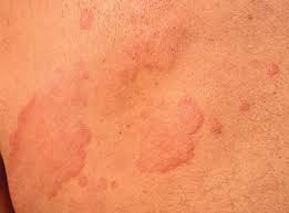 Best Chronic Urticaria treatment by Dr Swapna Priya, One of the Best Skin Specialist in Hyderabad
