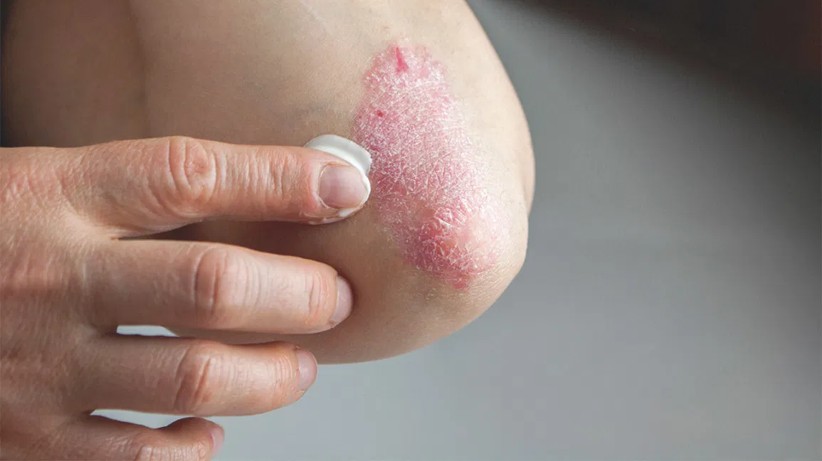 Best Psoriasis Treatment by Dr Swapna Priya, one of the Female Dermatologist Near me