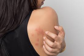 Consult Dr Swapna Priya, one of the best skin specialist in Hyderabad for Acute and Chronic Urticaria treatment