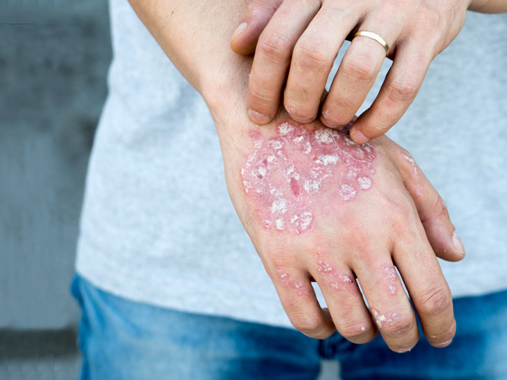 Consult with Dr Swapna Priya for Psoriasis at Cosmosure Clinic One of the Female Dermatologist Near me