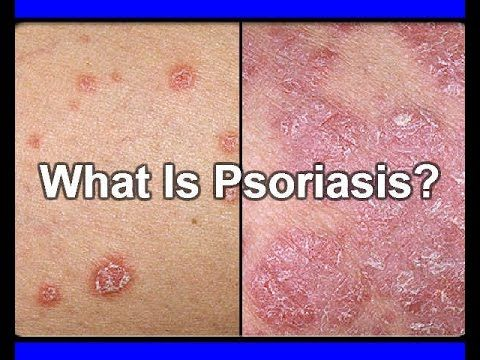 Best Treatment for Psoriasis by Dr Swapna Priya, one of the best Skin specialist in Hyderabad