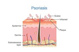 Best Psoriasis treatment by Dr Swapna Priya, One of the best skin specialist near me