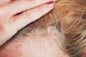 Consult to Dr. Swapna Priya for Scalp Psoriasis, One of the Best Skin Care doctor in Hyderabad